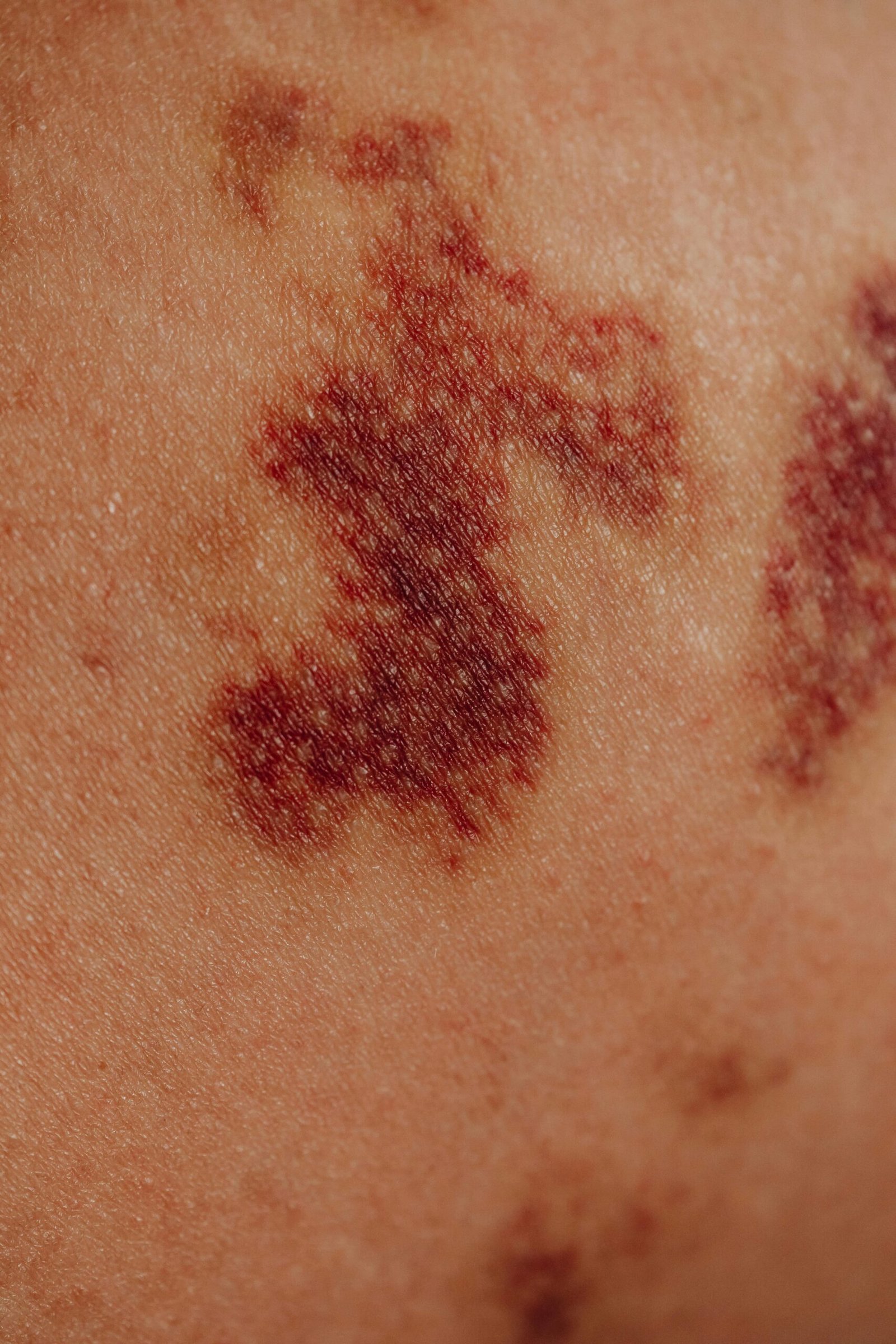 close up of inflamed skin showing immune system reaction and inflammation response