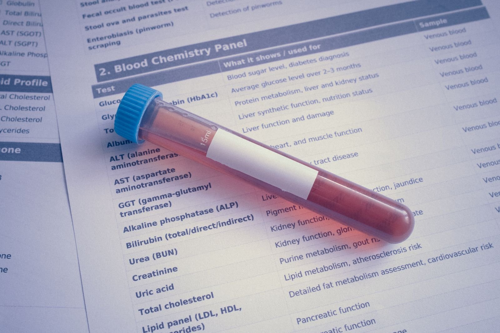 Blood sample tube resting on a lab report that lists a lipid panel with LDL, HDL and triglycerides